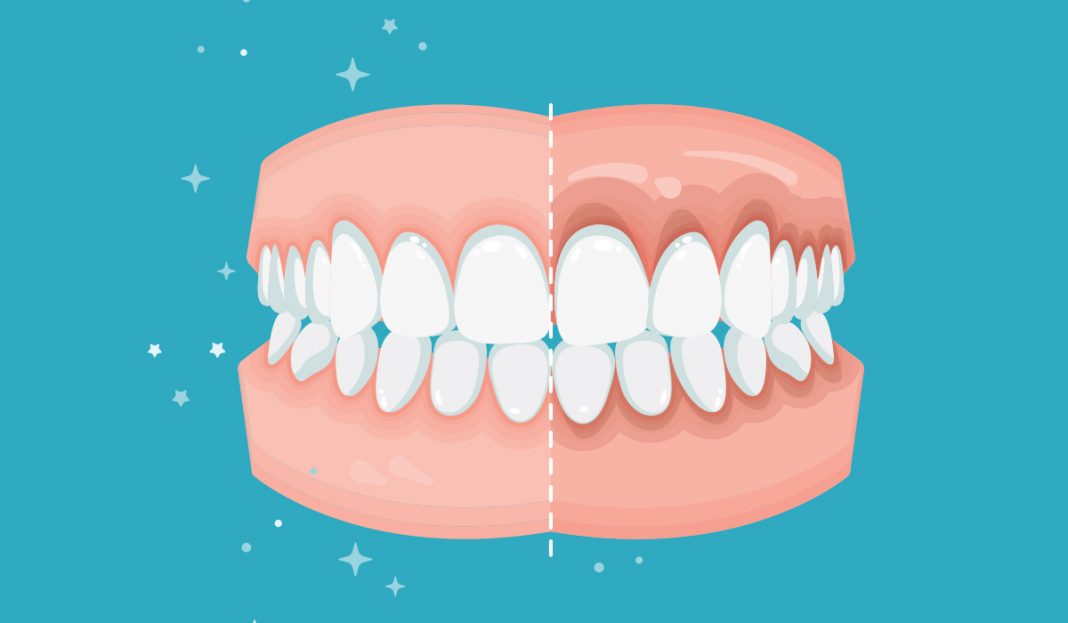 Diş Eti Çekilmesi Nedir, Nasıl Tedavi Edilir? En İyi Vitamin